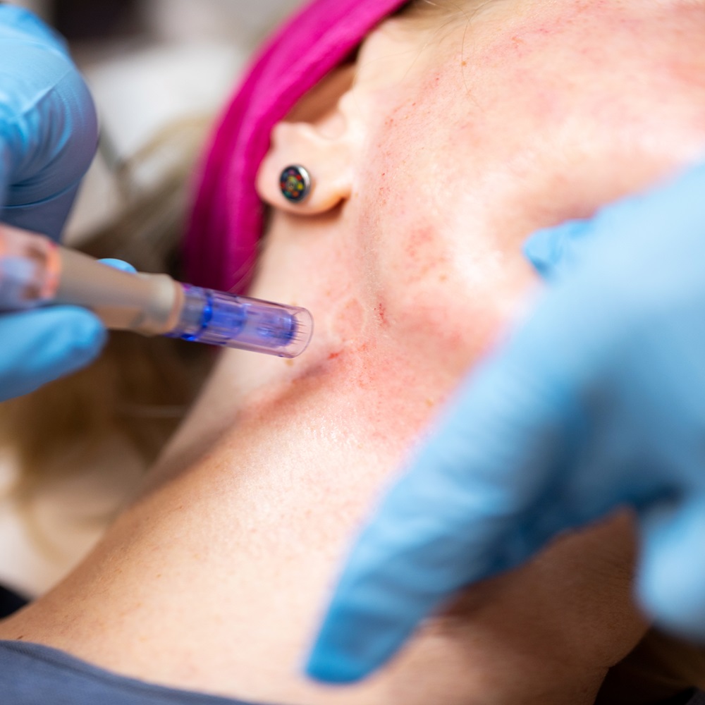 skin needling by refined by Alexandra, dermapen skin needling treatment